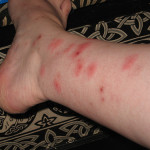 bed-bugs-bites